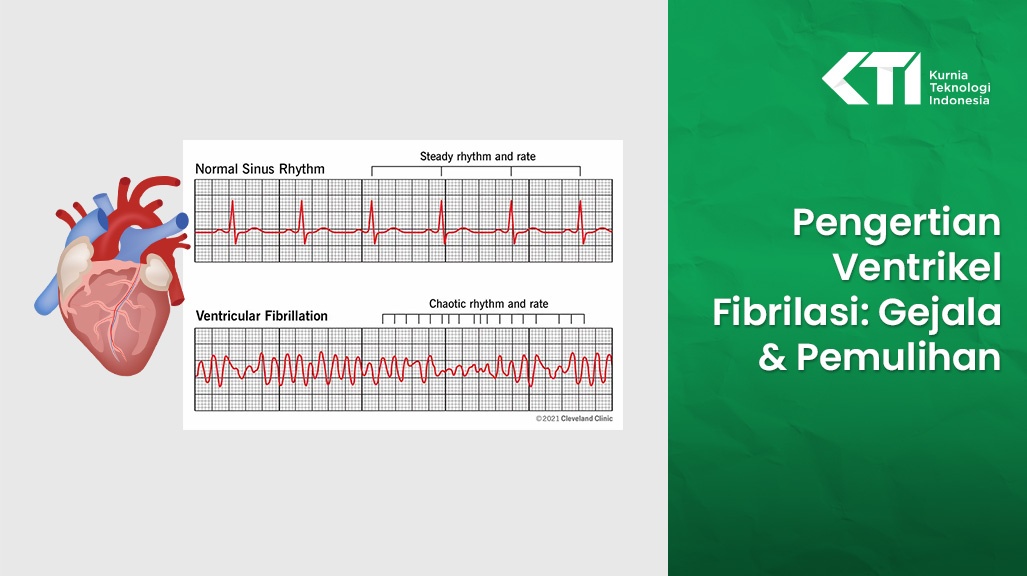 Pengertian Ventrikel Fibrilasi: Gejala & Pemulihan 